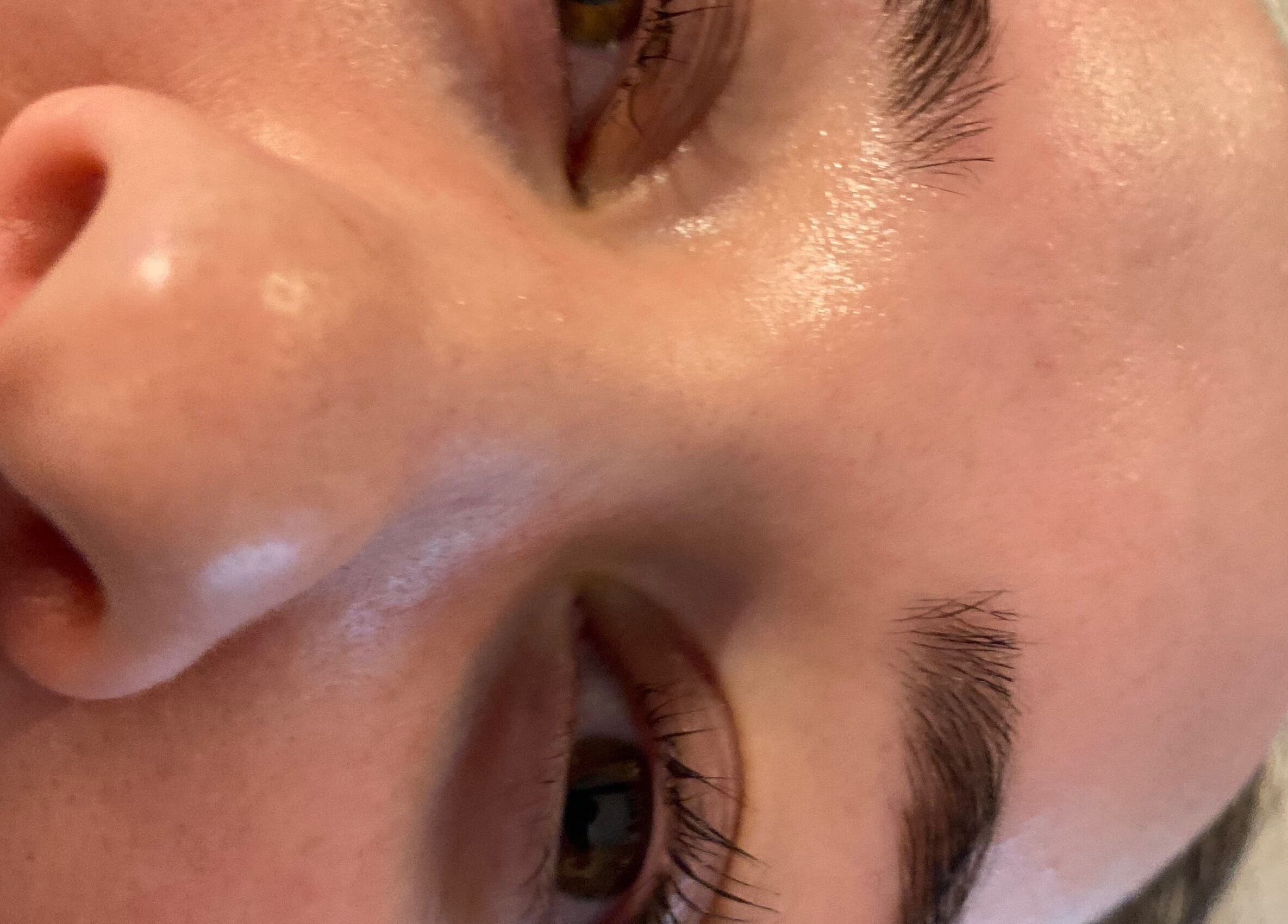 Close-up of a freshly treated face at By Keeley, Leicester, England, GB, showcasing smooth, glowing skin.