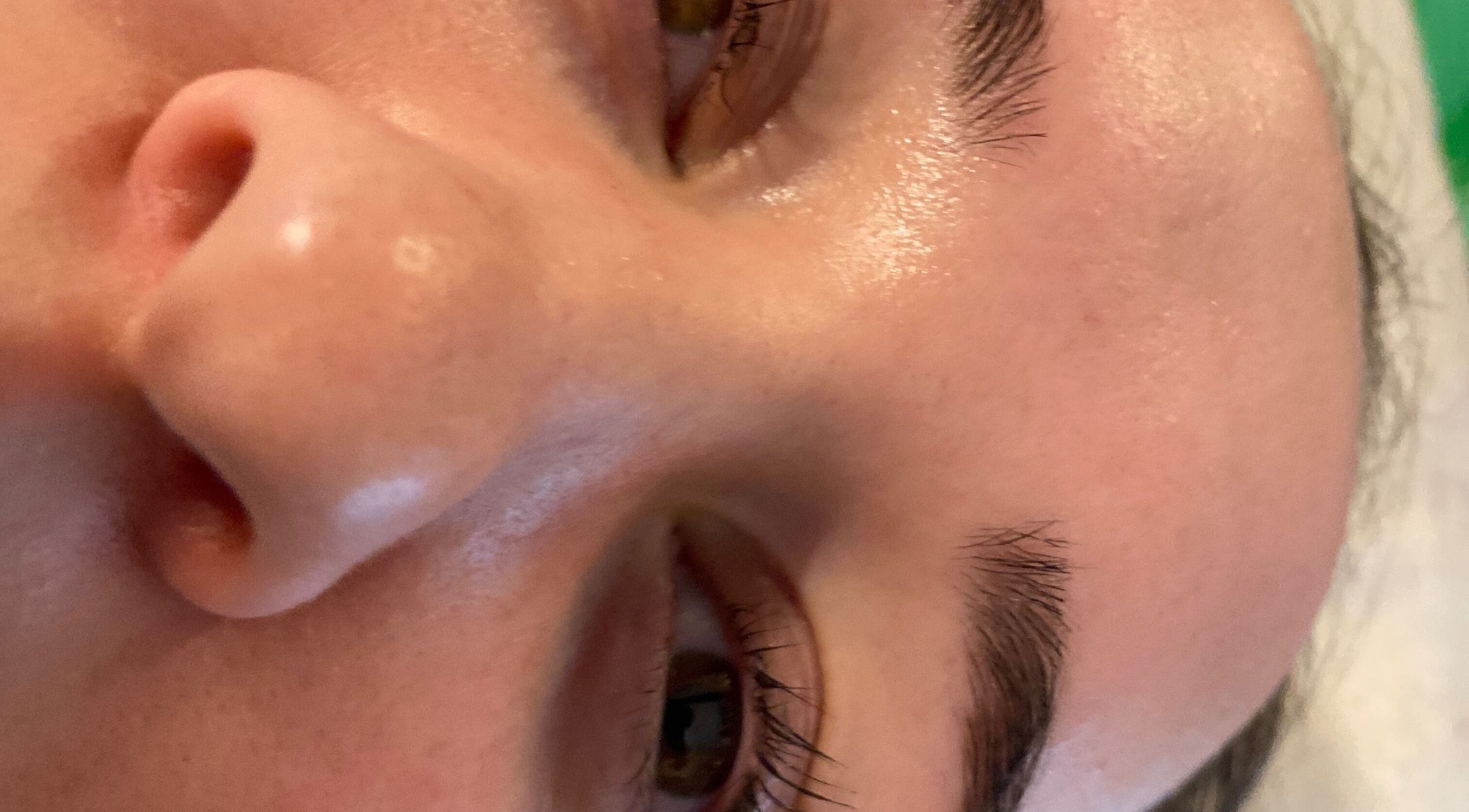 Close-up of a freshly treated face at By Keeley, Leicester, England, GB, showcasing smooth, glowing skin.