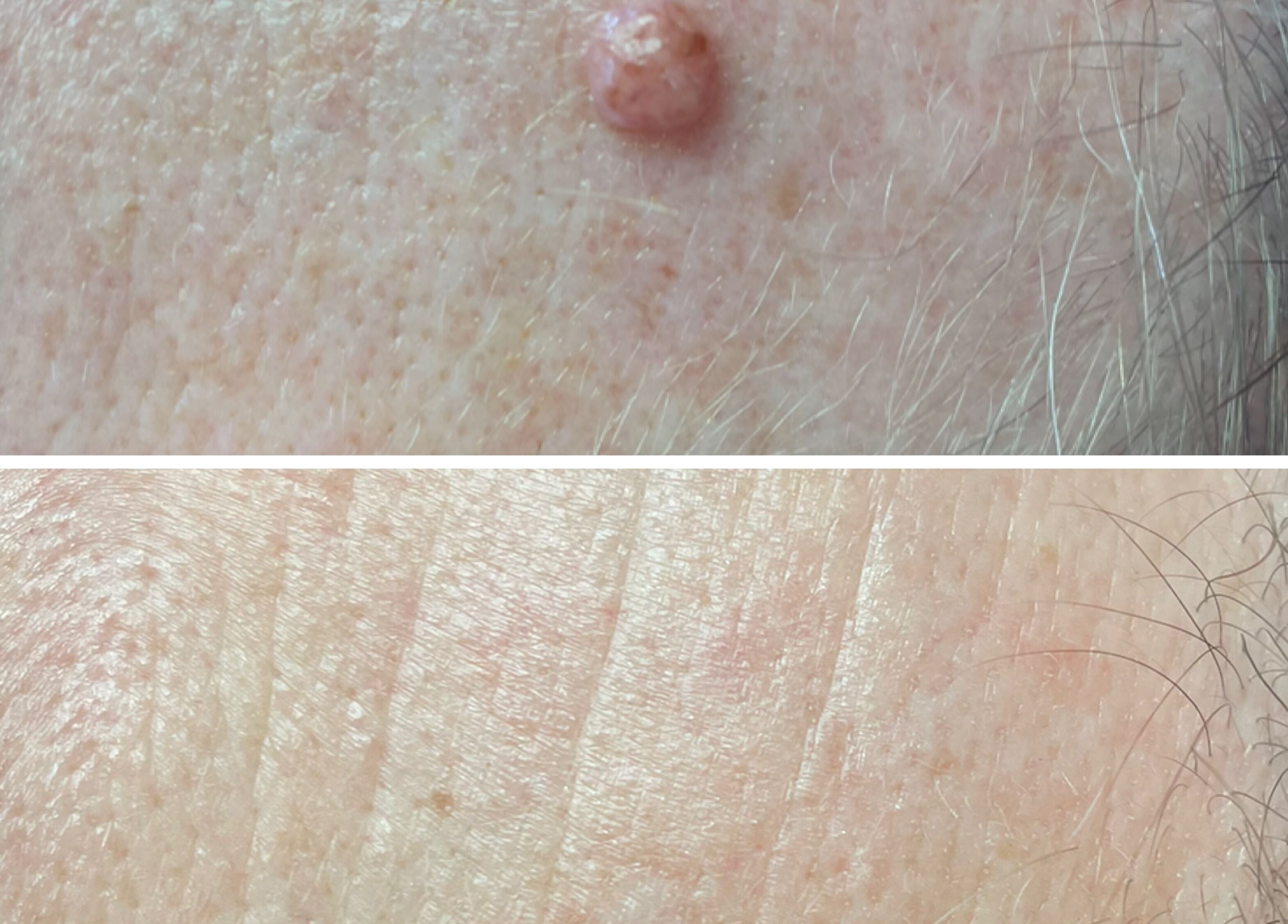 Before and after skin treatment at Skin Perfected Ferring, showing clear results in Ferring, England, GB.