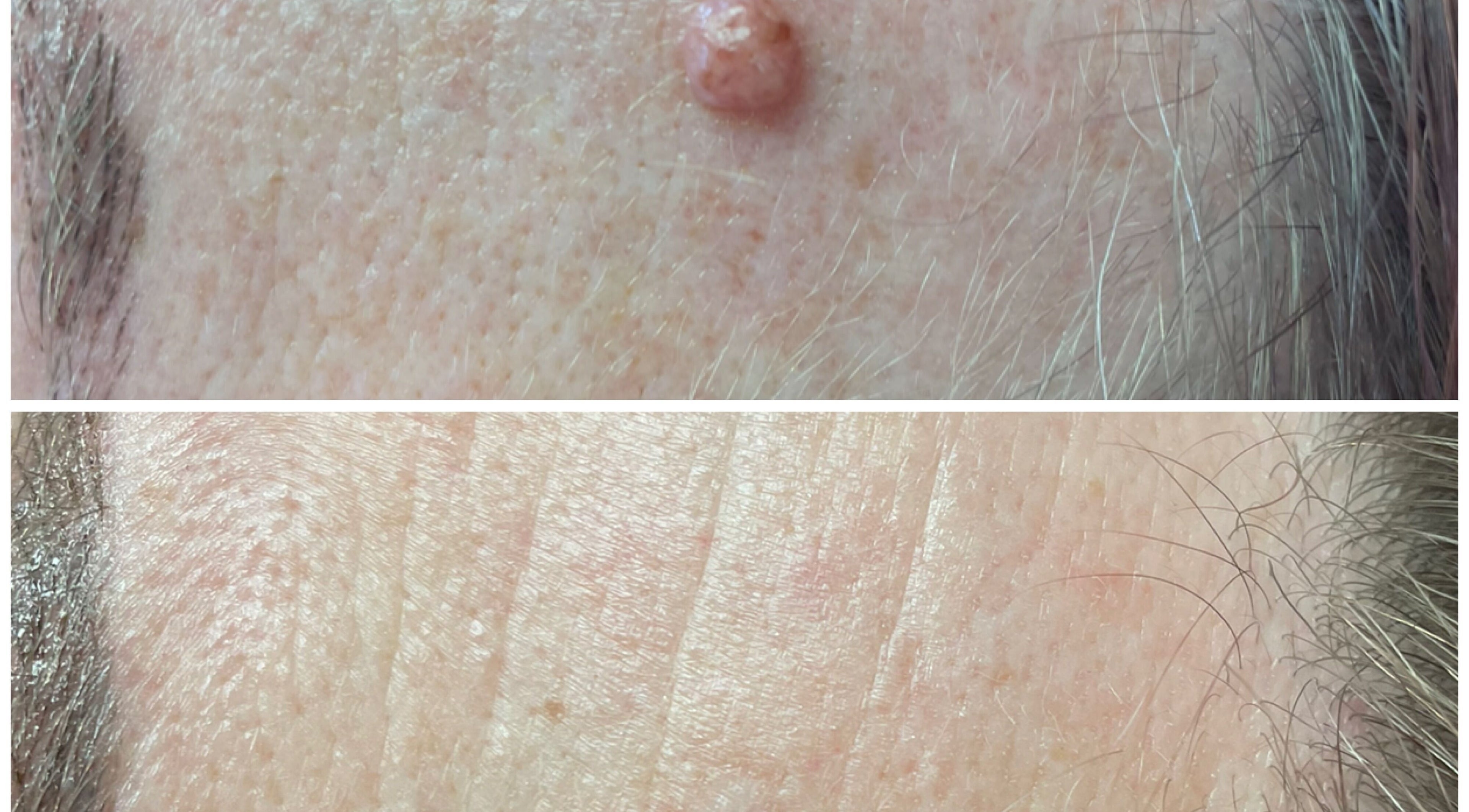 Before and after skin treatment at Skin Perfected Ferring, showing clear results in Ferring, England, GB.