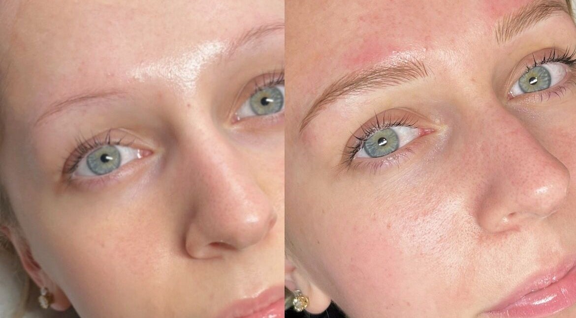 Before and after eyebrow enhancement at Amy Lorna Clinic, Waterloo, England, showcasing a natural transformation.