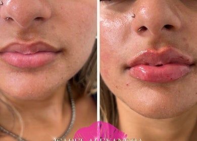 Before and after lip enhancement at Isabel Alexandra Aesthetics, Loughborough, England, GB.