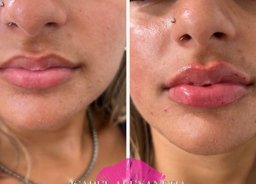 Before and after lip enhancement at Isabel Alexandra Aesthetics, Loughborough, England, GB.