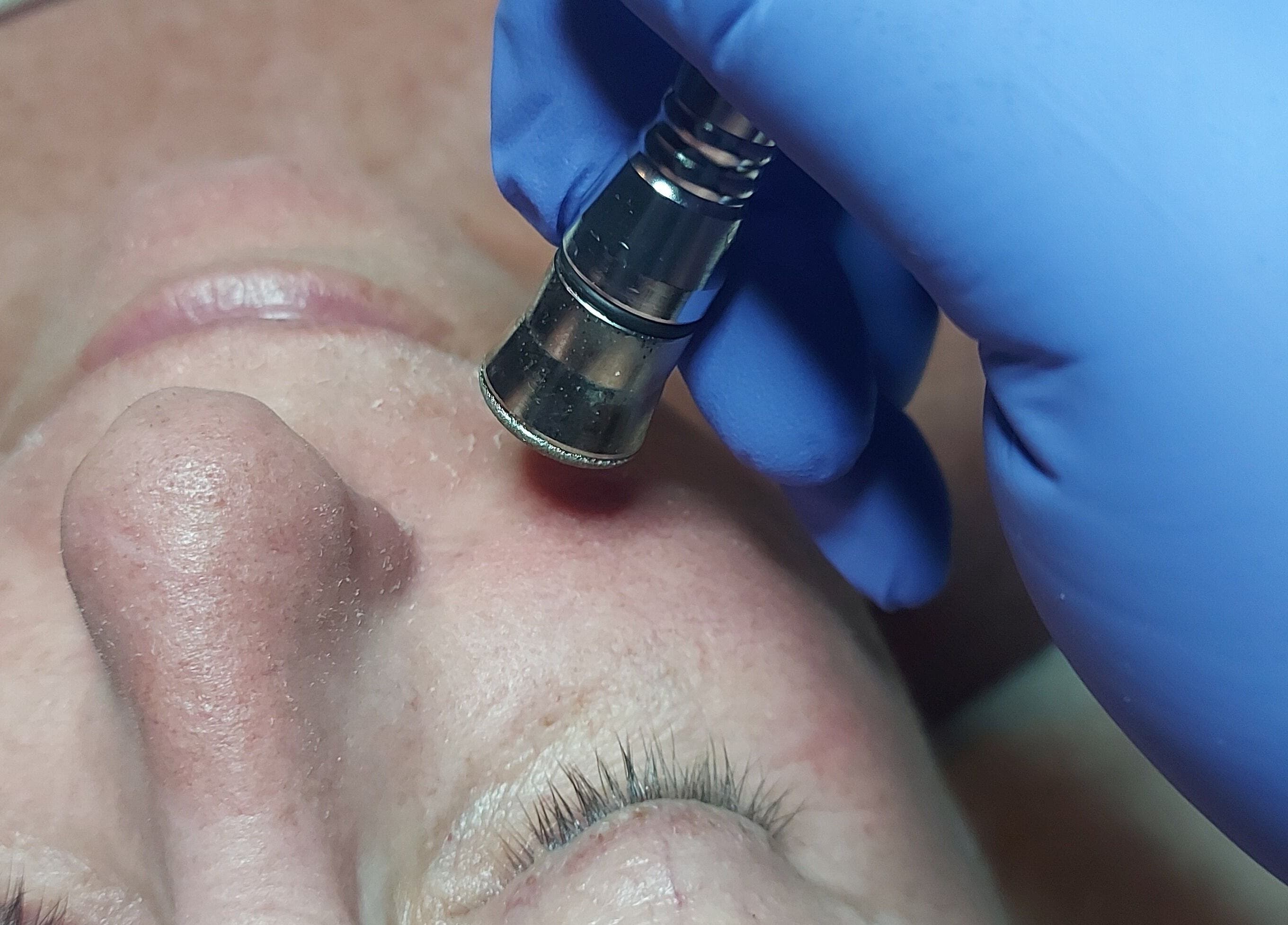 Close-up of microdermabrasion at The Sea View Spa at February Point, Exuma, Exuma, BS enhancing skin radiance.