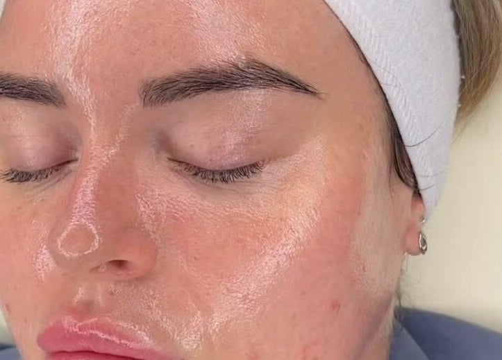 Facial treatment at Synergy Aesthetics Bexley in Bexley, England, GB, showcasing skin rejuvenation.