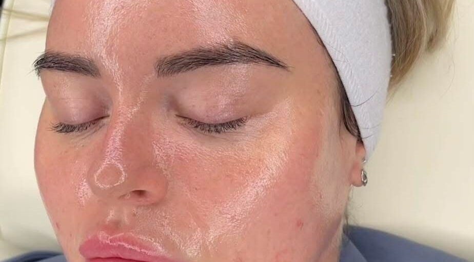 Facial treatment at Synergy Aesthetics Bexley in Bexley, England, GB, showcasing skin rejuvenation.