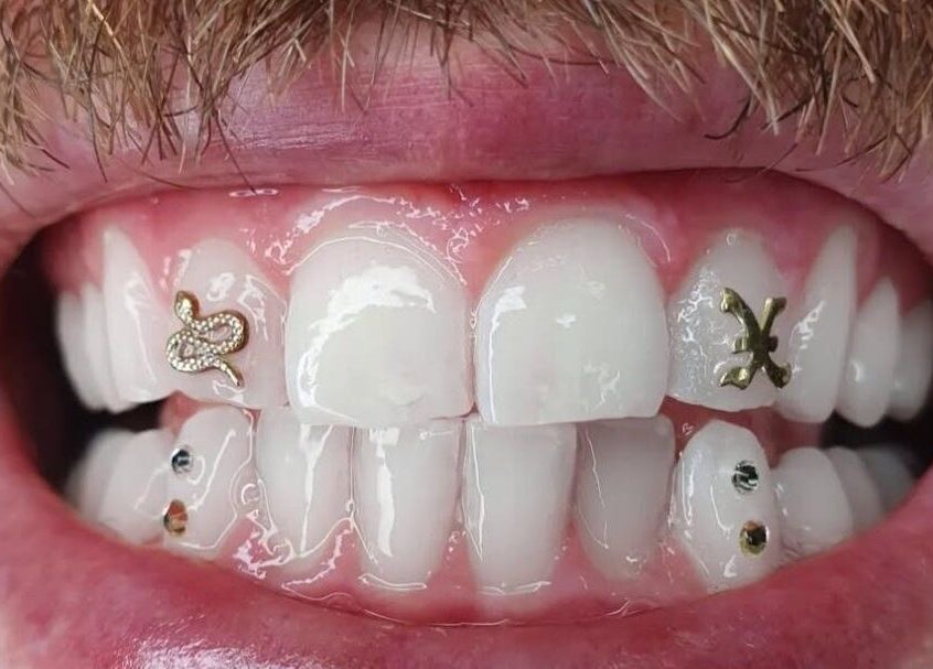 Customized tooth jewelry at KTF Studios, Cardiff, Wales, GB. Stylish dental bling showcasing unique charm.