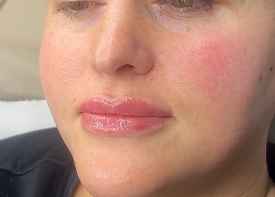 Close-up of glowing skin after treatment at Fill My Needs Aesthetics Academy, Hadleigh, England, GB.