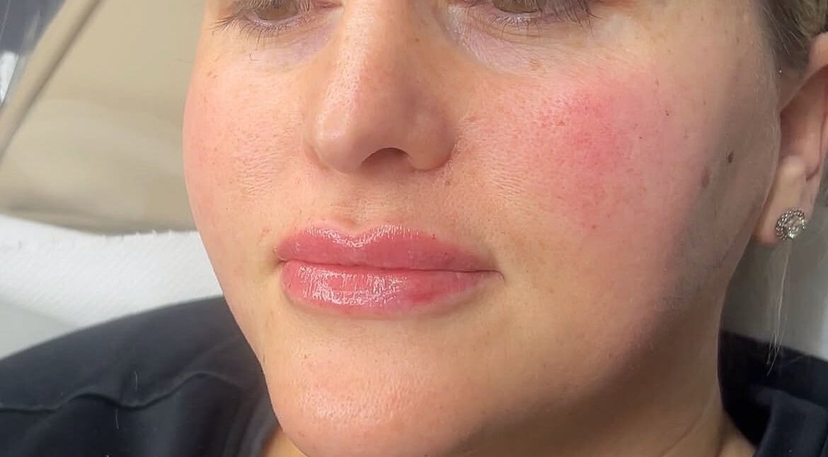 Close-up of glowing skin after treatment at Fill My Needs Aesthetics Academy, Hadleigh, England, GB.