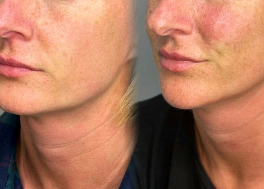 Before and after skincare results at Fill My Needs Aesthetics Academy, Hadleigh, England, GB.