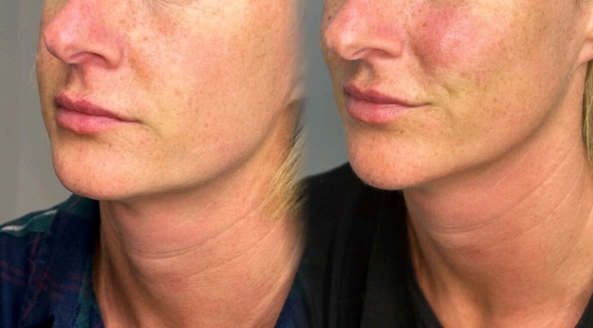 Before and after skincare results at Fill My Needs Aesthetics Academy, Hadleigh, England, GB.