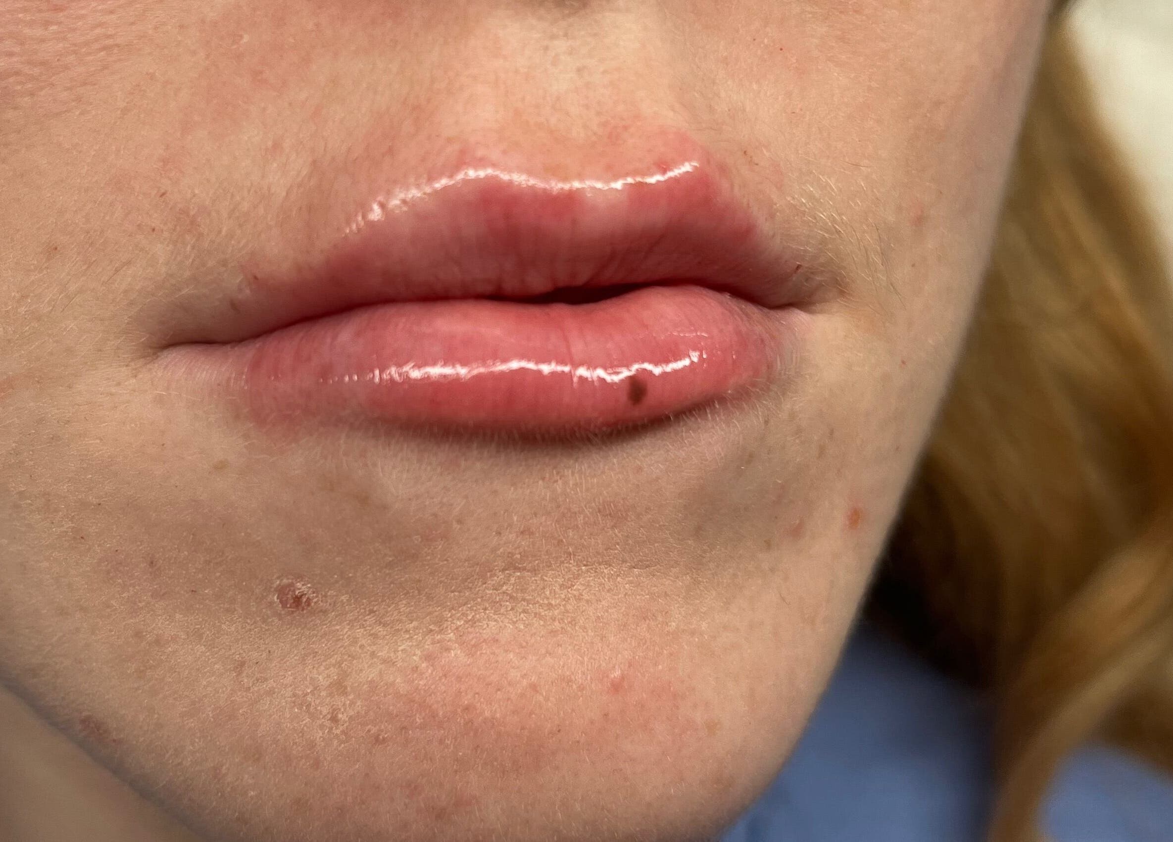 Close-up of glossy lips after treatment at Natural Aesthetics, Stoke-on-Trent, England, GB.