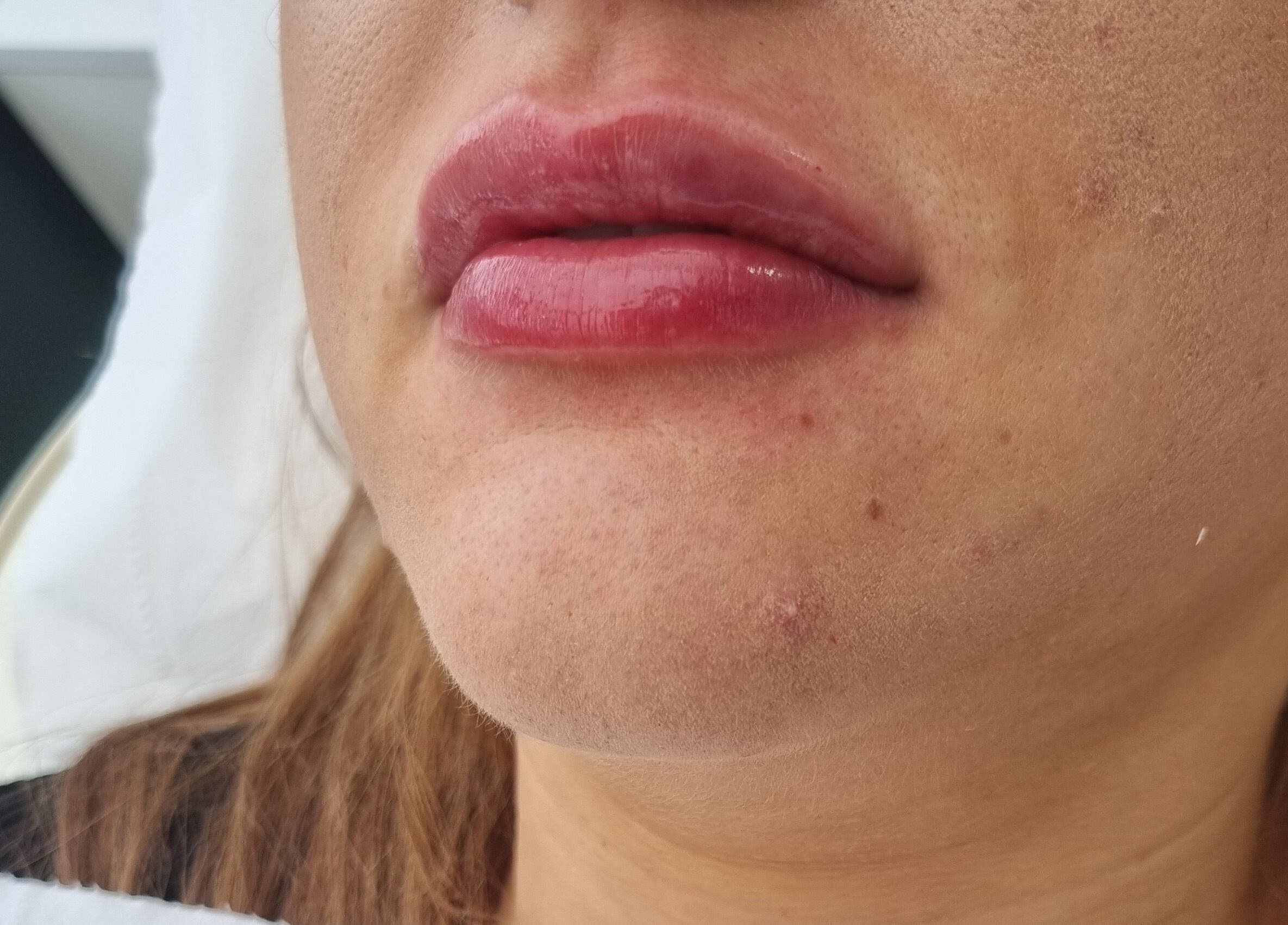 Close-up of a client's enhanced lips at Natural Aesthetics, Stoke-on-Trent, England, GB.