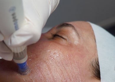 Skin treatment in progress at Skin Wellness Clinic, HIGHETT, Victoria, AU. Woman receiving hydra facial therapy.
