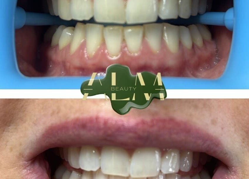 Teeth whitening at ALM Beauty, Brighton And Hove, England. Before and after close-up of dental transformation.