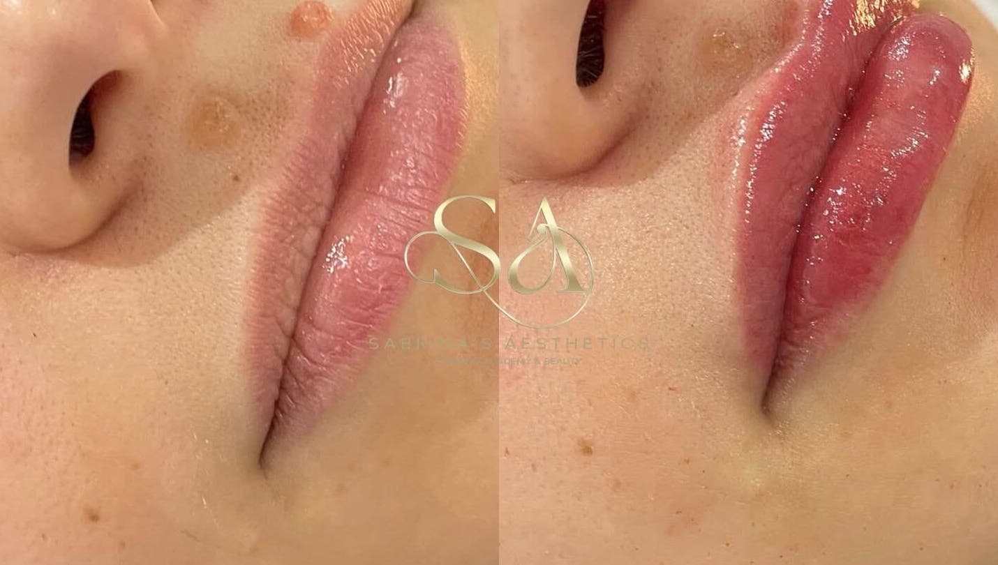 Close-up of lip enhancement at Camden London, London, England, GB showcasing before and after results.