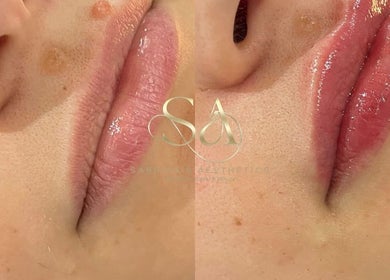 Close-up of lip enhancement at Camden London, London, England, GB showcasing before and after results.
