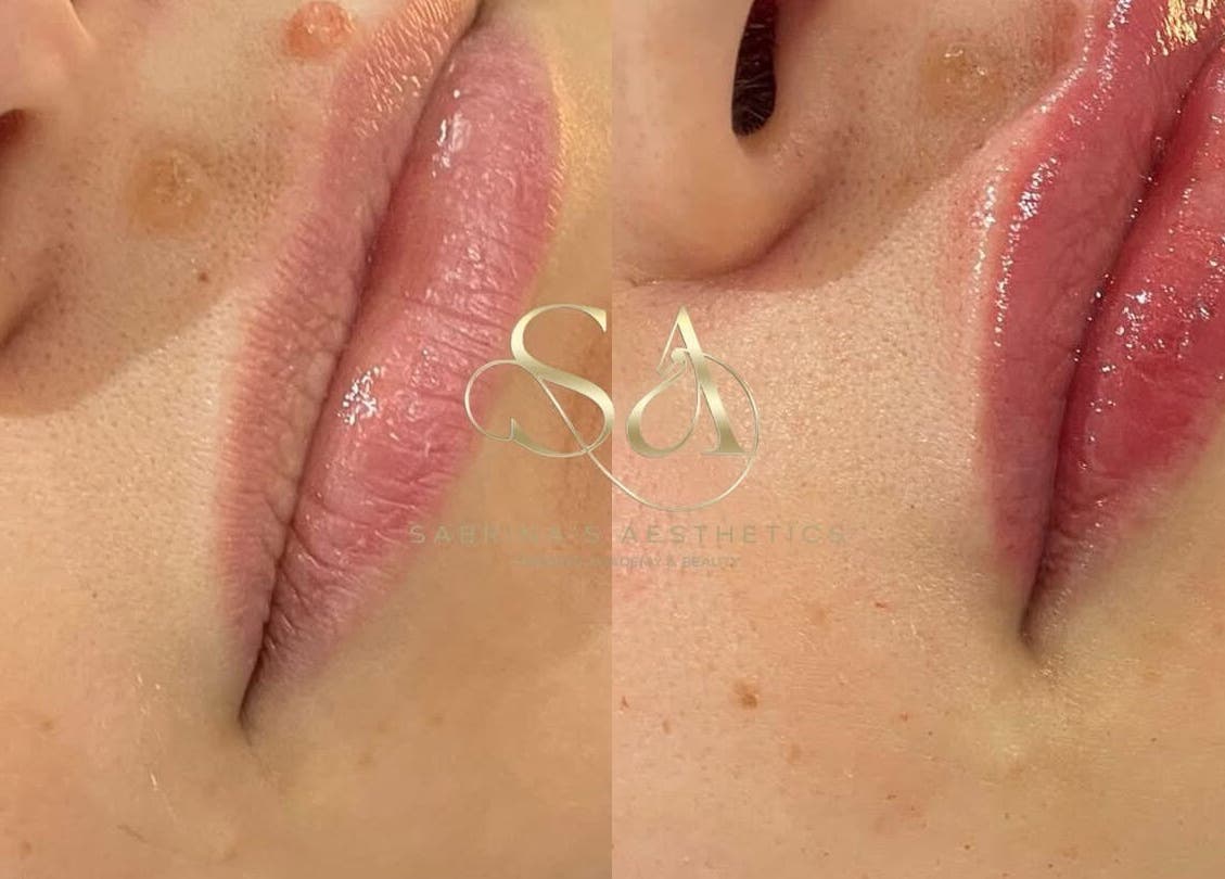 Close-up of lip enhancement at Camden London, London, England, GB showcasing before and after results.