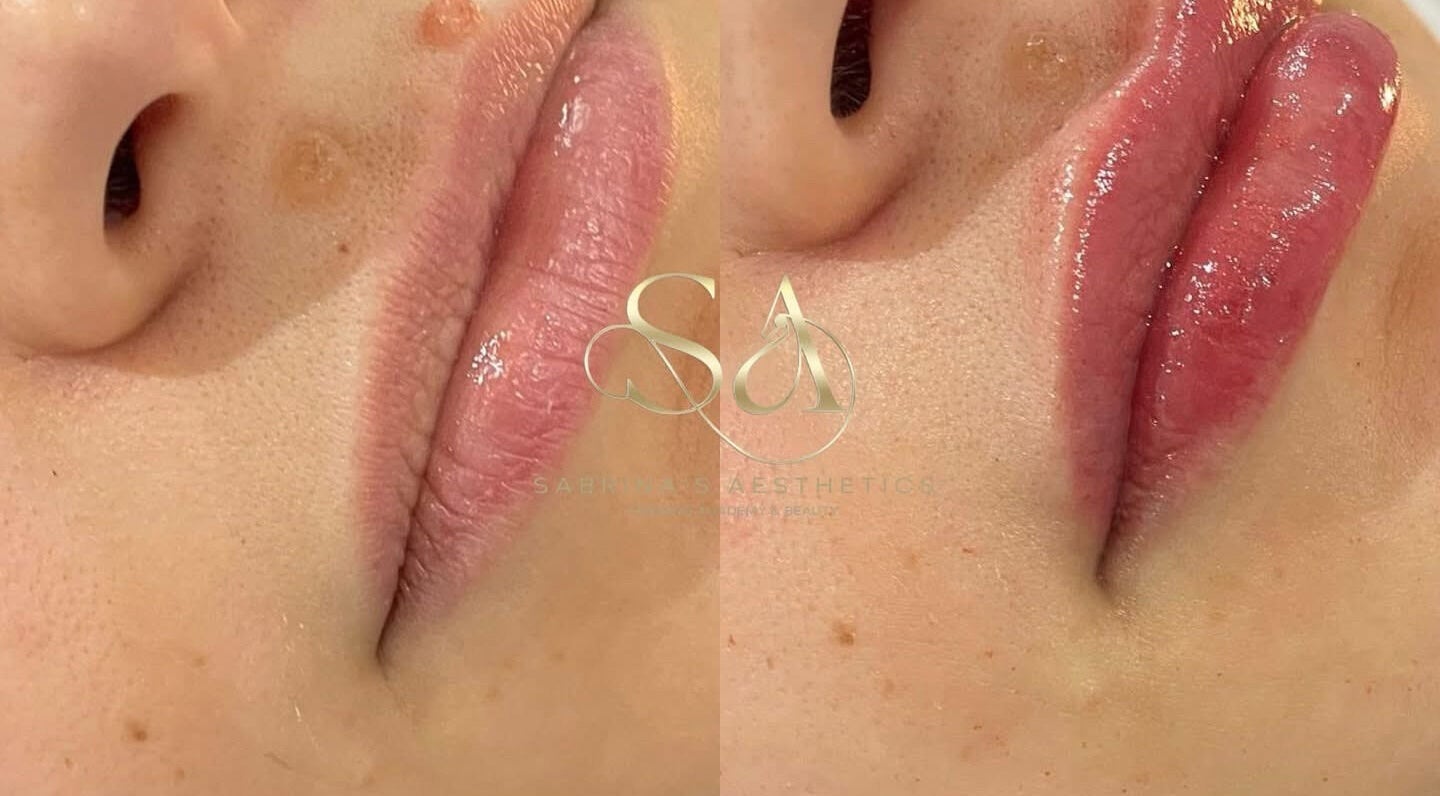 Close-up of lip enhancement at Camden London, London, England, GB showcasing before and after results.