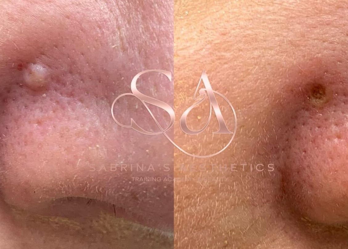 Close-up of skin before and after treatment at Camden London, London, England, GB.