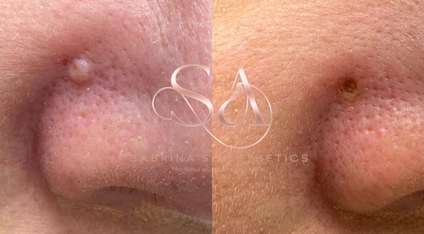 Close-up of skin before and after treatment at Camden London, London, England, GB.