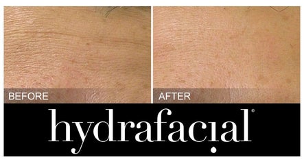 Hydrafacial Cardiff