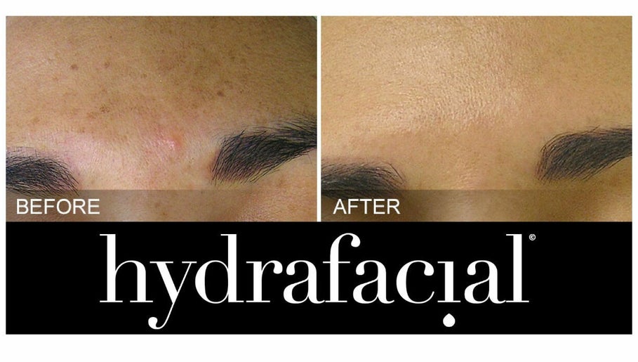 Hydrafacial Cardiff  afbeelding 1