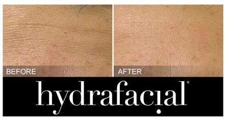 Hydrafacial Cardiff صورة 3