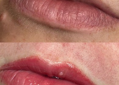 Lip transformation at Eala Beauty, Northern Ireland, Northern Ireland, GB showcasing before and after enhancement.