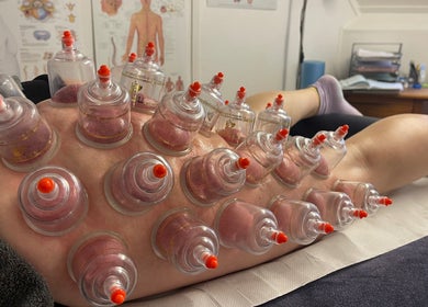 Cupping therapy at Farnborough Sports Massage in Farnborough, England, GB. Cups placed on the back for relaxation.