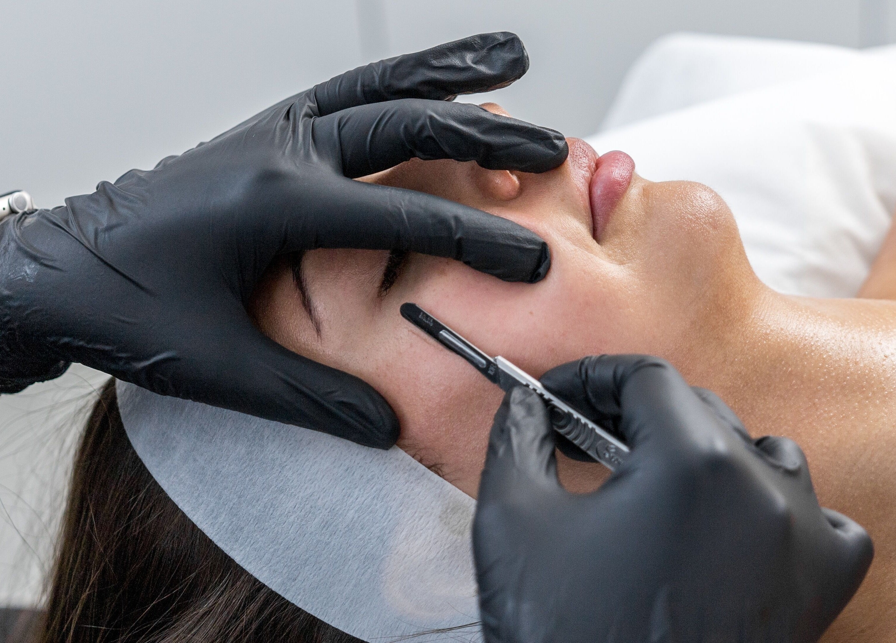 Dermaplaning treatment at Simply Luminous Skin, Wentworth Point, New South Wales, AU enhancing facial smoothness.