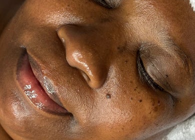 Glowing skin treatment at Sculpted Aesthetic Miami in Miami Lakes, Florida, US.