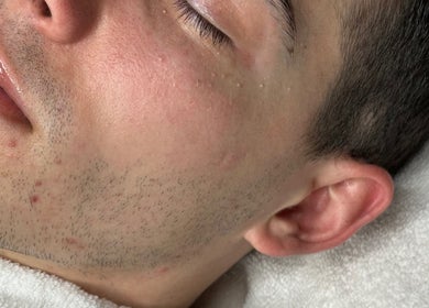 Close-up of man's clear skin after facial at Sculpted Aesthetic Miami, Miami Lakes, Florida, US.