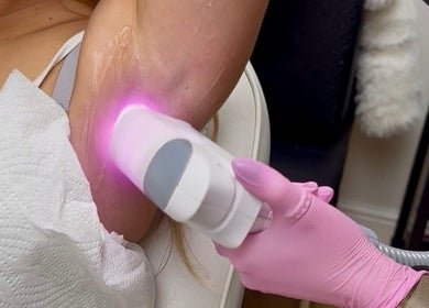 Laser treatment on arm at ER Laser Clinic, Wisbech, England, GB for smooth skin.