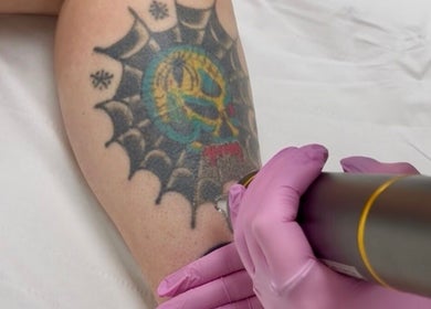 Laser tattoo removal in progress at ER Laser Clinic, Wisbech, England, GB using advanced technology.