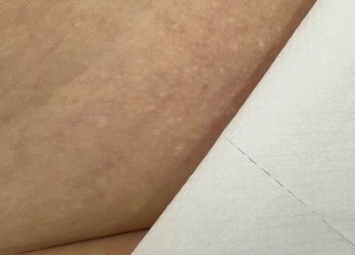 Smooth skin prepared for treatment at ER Laser Clinic, Wisbech, England, GB with soft towel layer.