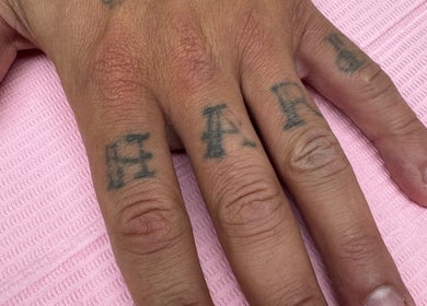 Close-up of hand tattoo at ER Laser Clinic, Wisbech, England, GB, showcasing tattoo removal service.