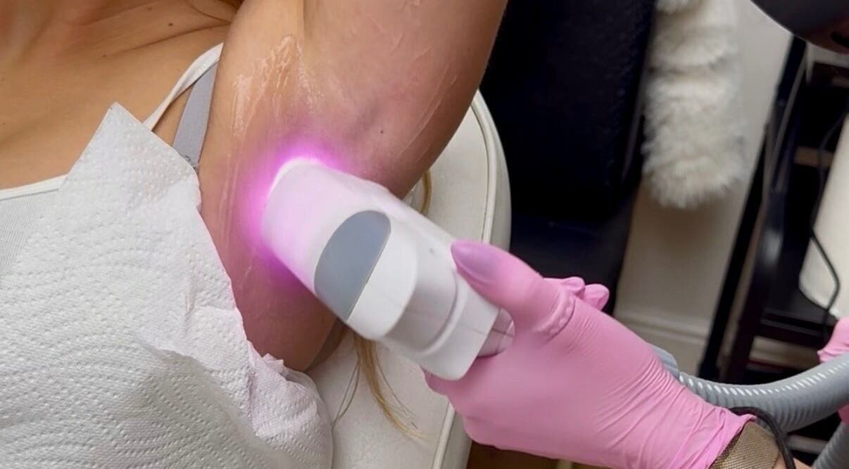 Laser hair removal at ER Laser Clinic & Piercing in Wisbech, England, GB, showcases precision hair reduction.