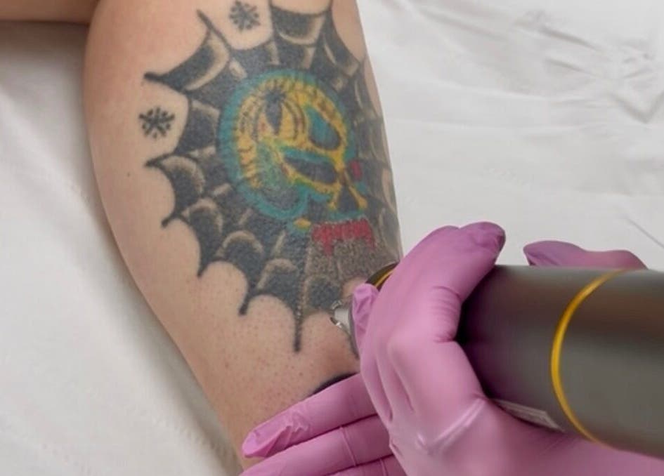 Tattoo removal in progress at ER Laser Clinic & Piercing, Wisbech, England, GB, showcasing precision treatment.