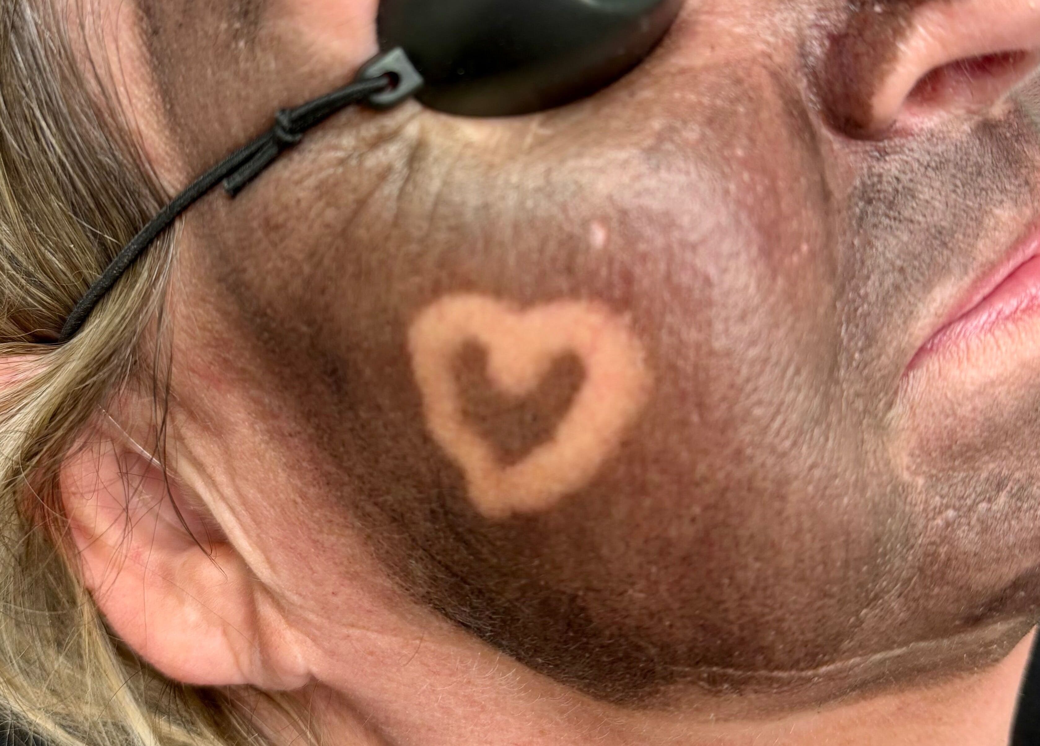 Heart-shaped glow on cheek during face treatment at ER Laser Clinic & Piercing, Wisbech, England, GB.