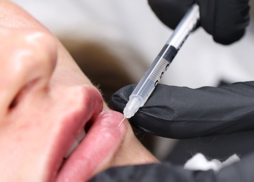 Lip filler treatment at Impeccable Aesthetics, Warrington, England, GB, showcasing precision and expertise.