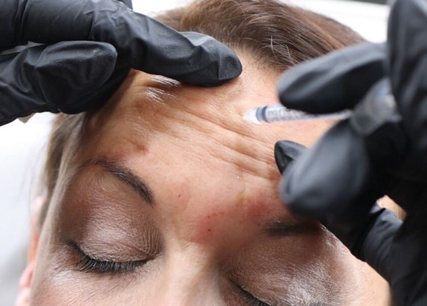 Professional aesthetic treatment at Impeccable Aesthetics, Warrington, England, GB, for youthful forehead.