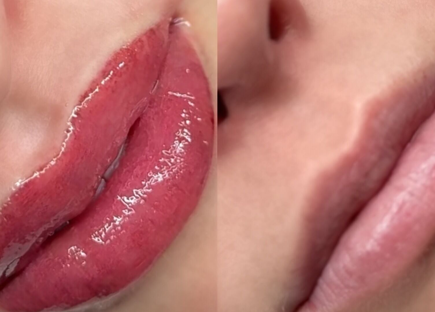 Lip enhancement by Brow Obsession Specialist in Dee Why, New South Wales, AU showcasing a glossy finish.