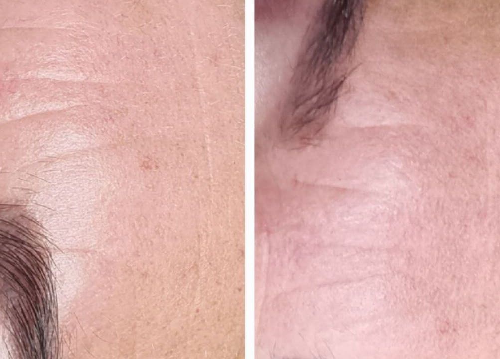 Before and after skin care at BeUCare Esthetics and Wellness Lounge, Paramaribo, Paramaribo, SR.