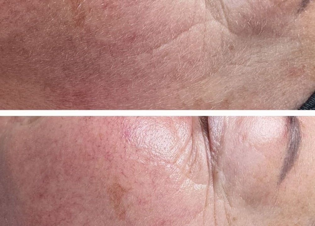 Before and after skin treatment at BeUCare Esthetics and Wellness Lounge, Paramaribo, Paramaribo, SR.