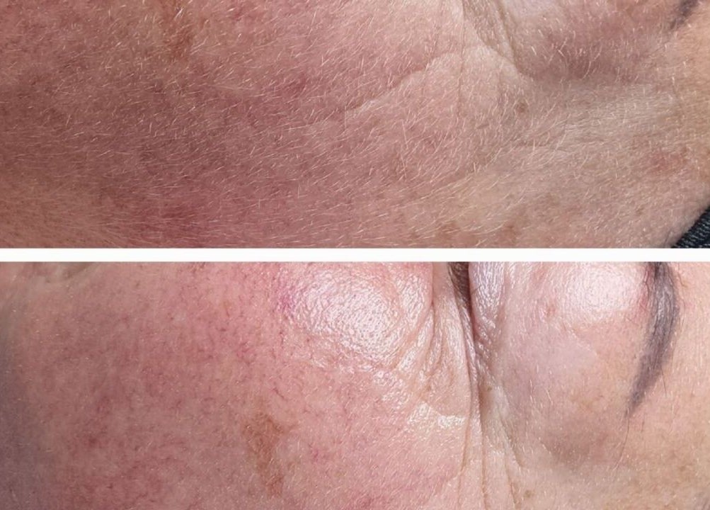 Before and after skin treatment at BeUCare Esthetics and Wellness Lounge, Paramaribo, Paramaribo, SR.