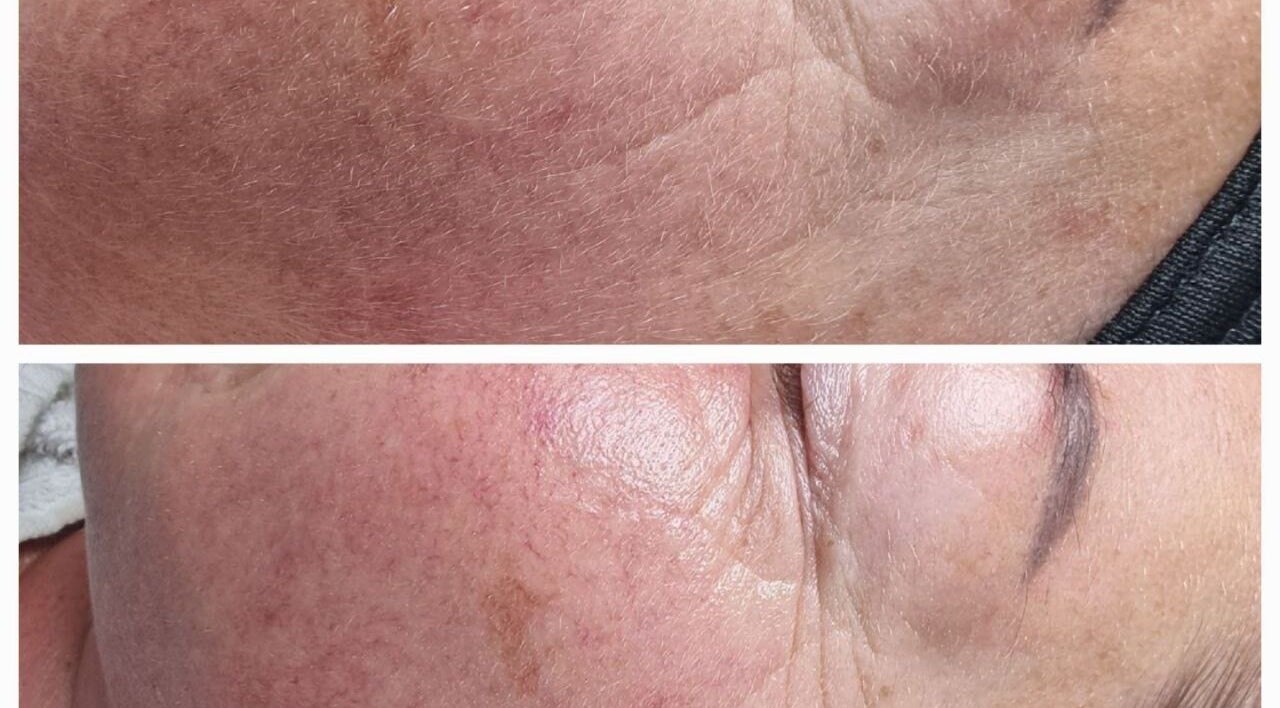 Before and after skin treatment at BeUCare Esthetics and Wellness Lounge, Paramaribo, Paramaribo, SR.