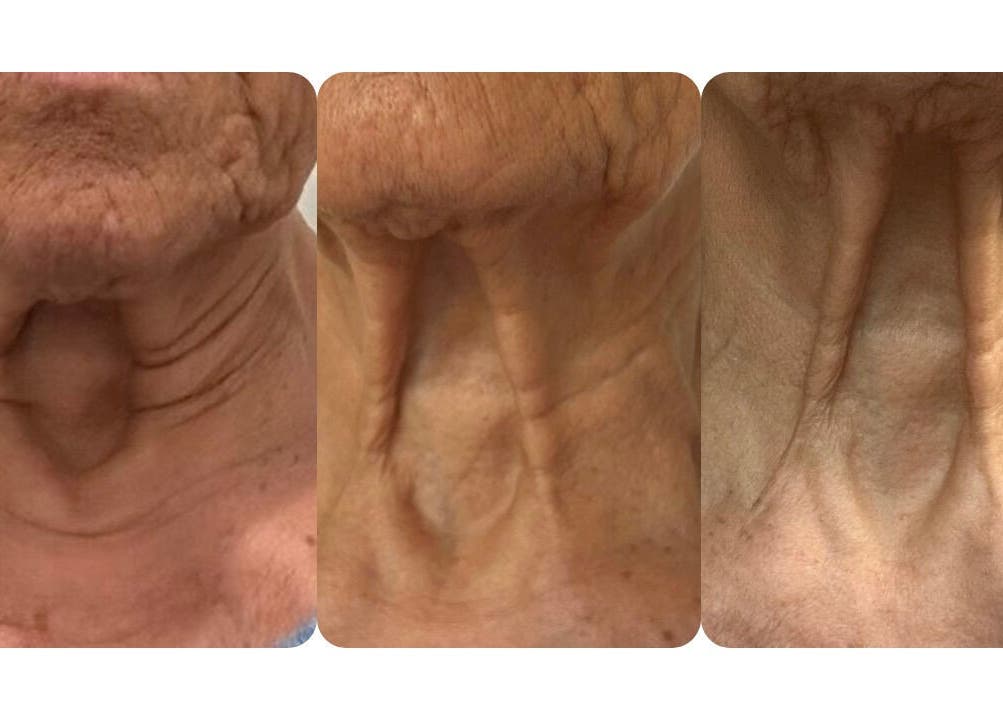 Neck skin rejuvenation progress at BeUCare Esthetics and Wellness Lounge, Paramaribo, Paramaribo, SR.