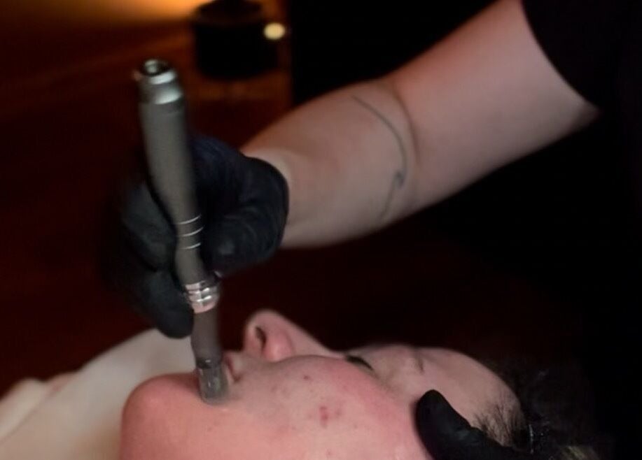 Microneedling treatment at Face:it in Borve, Scotland, GB, enhancing skin rejuvenation with precision.