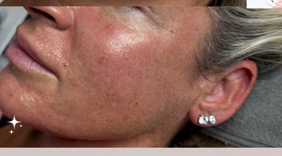 Close-up of glowing skin after treatment at Sknn Aesthetics by Shen, Cheshunt, England, GB.